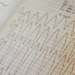ECG